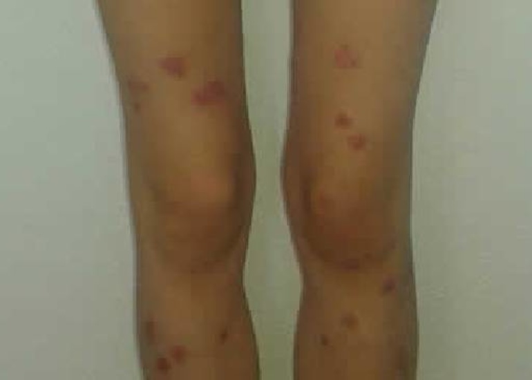 Psorijaza kod dece: Priča o nadi i oporavku